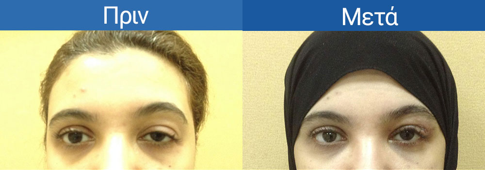 Βλεφαρόπτωση