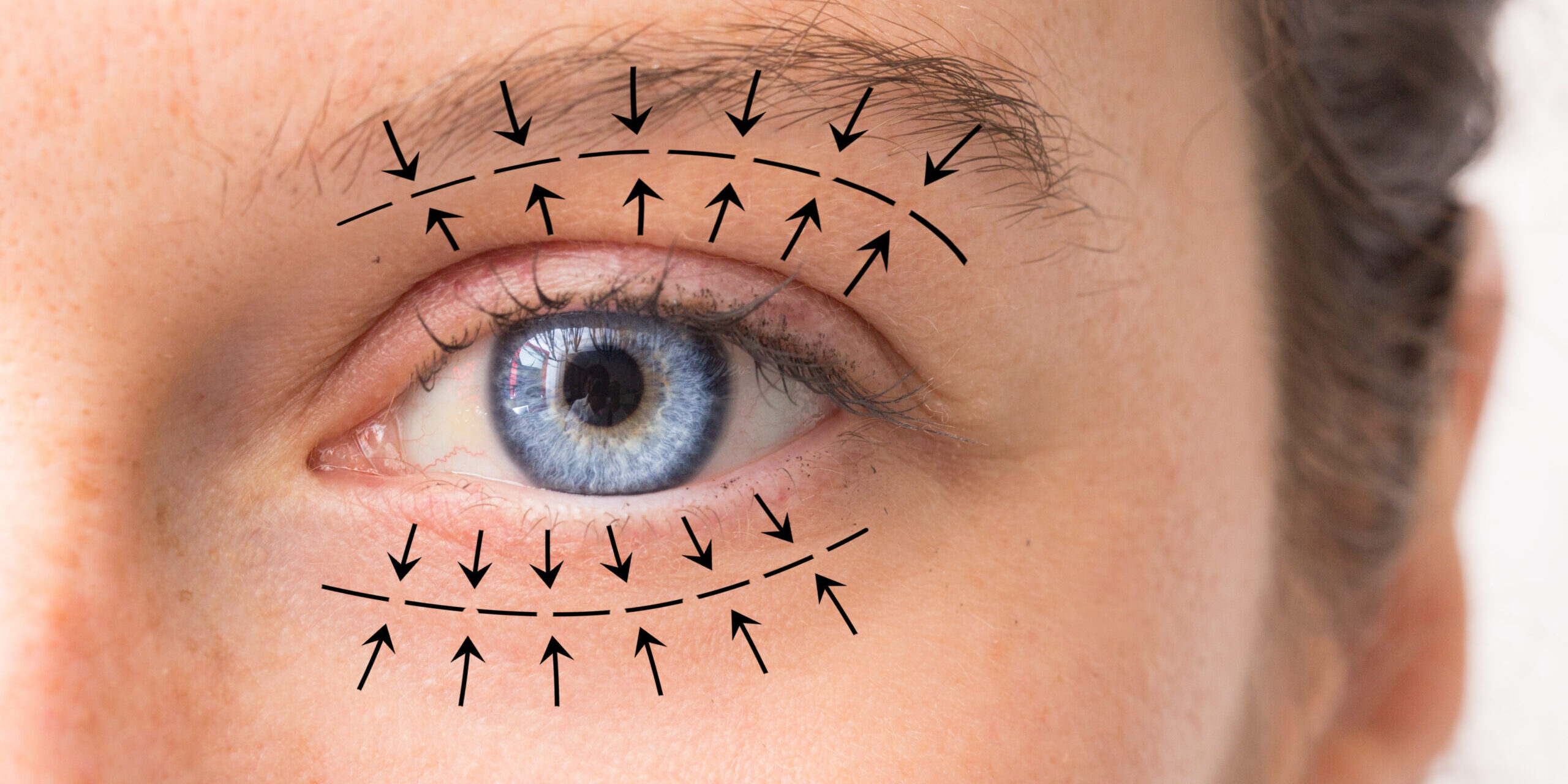 A macro view on the pretty blue eye of a Caucasian girl in her 30s. Arrows point in the direction of planned oculoplastic surgery to tighten and lift the skin around the eyes.